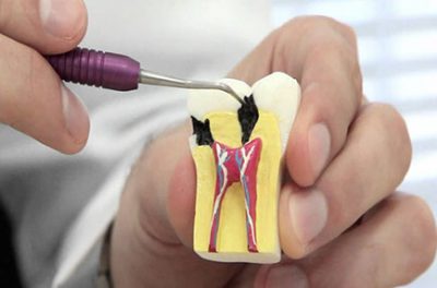 endodontia-2